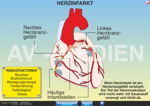 Herzinfarkt