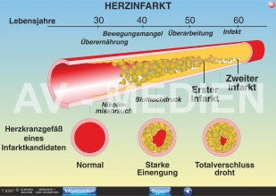 Herzinfarkt