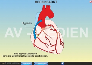 Herzinfarkt