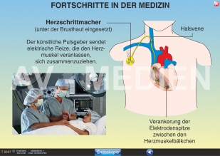 Herzinfarkt