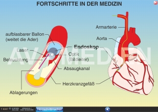 Herzinfarkt